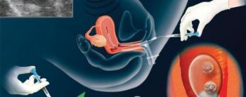 Embryo Transferi Sonrasında Ne Yapılmalıdır?